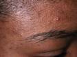 This image displays numerous whiteheads (closed comedones) and acne pus-filled lesions on the forehead.
