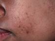 This image displays one raised acne lesion and several flat, dark spots from prior inflammation, which may take months to resolve due to the patient's darker skin.