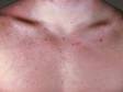 This image displays mild pus-filled lesions and bumps of acne on the chest.