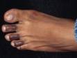 This image displays callous areas of the upper toes, which are darker in this Black patient.
