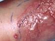 This image displays tense blisters typical of cellulitis.