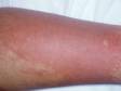This image displays the redness (erythema) typically present in cellulitis.