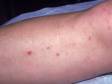 After the initial small, red bump or pus-filled lesion, folliculitis lesions often form a small crust or scab.