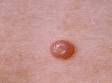 Molluscum contagiosum is a benign, poxvirus infection that typically has a central depression.