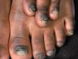 This image displays thick, uneven, rough nails typical of onychomycosis.