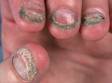 This image displays nails that have broken and not regrown to normal length, typical of onychomycosis.