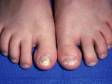 This image displays both great toenails infected with fungus.