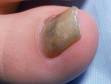 The great toenail is the most likely area to be affected with a fungus, with discoloration and thickening of the nail plate.