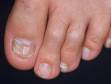 The great and third toenails show the thickened and slightly discolored appearance typical of fungal infection.