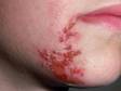 This image displays an unusual area for the herpes simplex infection.