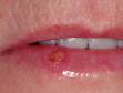 This image displays a mucosal blister caused by a herpes simplex infection.