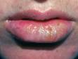 This image displays early crusting and swelling typical of recurrent herpes.