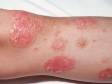 This image displays a close-up of the scaly, slightly elevated lesions of psoriasis, which often appear to come off in plates.