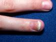 This image displays an uneven, pitted nail separated from the nail bed due to psoriasis.