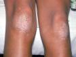 This image displays knees affected by psoriasis.