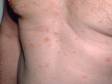 Psoriasis can also present with multiple smaller lesions that are widely distributed on the body.
