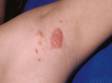 This image displays the fine, scaly, slightly elevated lesions in the armpit (axilla) in psoriasis.