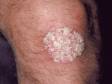 In psoriasis, this is a typical elevated lesion with white scale on the knee.