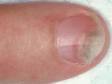 This image displays a separation of the nail from the bed (onycholysis) caused by psoriasis.