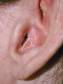 Psoriasis of the ear typically involves the ear canal and appears as redness with white scale.