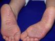 Psoriasis on the bottoms of feet may affect the instep of the sole as well as areas of friction.