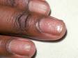 Psoriasis may be evident in the nails with multiple tiny, pit-like depressions of the nail plate surface.