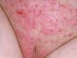 Psoriasis frequently occurs in the genital area of men and women. Psoriasis is not contagious and is not spread sexually.