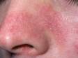 This image displays the fine scaliness and redness of the nose and cheek typical of seborrheic dermatitis.
