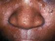 This image displays faint redness and scaling along the creases of the nose typical of seborrheic dermatitis on people with darker skin.