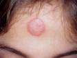 Tinea infection (ringworm) is characterized by a pink to red round, scaling patch.