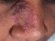 This image displays how tinea faciale (ringworm of the face) can present on dark skin.