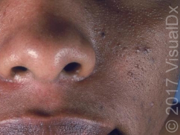 Acne Scarring: Established and New Treatment Strategies | skinsight