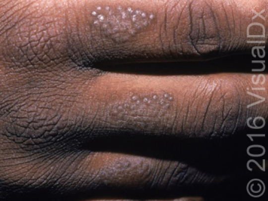 5 Things You Should Know About Atopic Dermatitis | skinsight