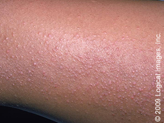 Atopic dermatitis (eczema)
