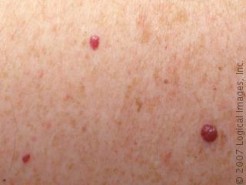 Red Moles On Skin Skinsight