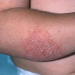 5 Common Triggers For Childhood Eczema Skinsight