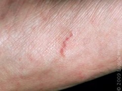 What is a scabies rash?